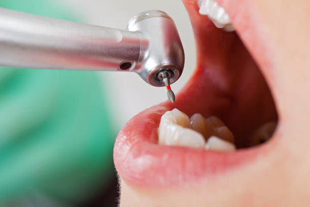 Best Emergency Dental Extractions in Navarre Beach, FL